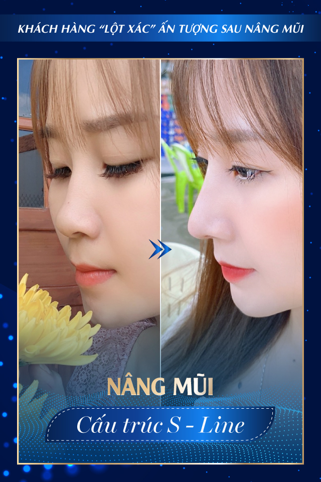 Nâng mũi công nghệ cao - Tmv Nguyễn Thế Thạnh