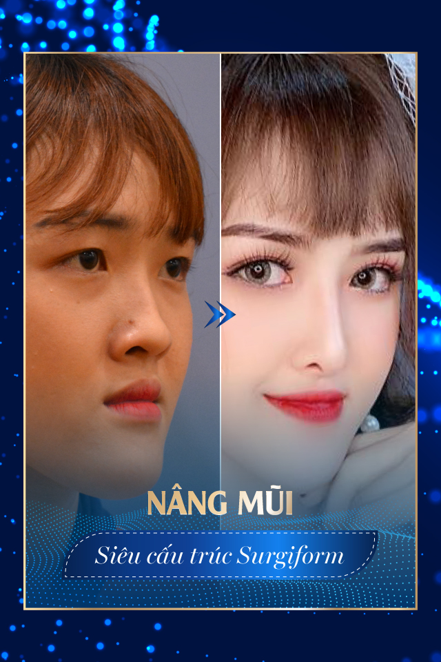 Nâng mũi công nghệ cao - Tmv Nguyễn Thế Thạnh