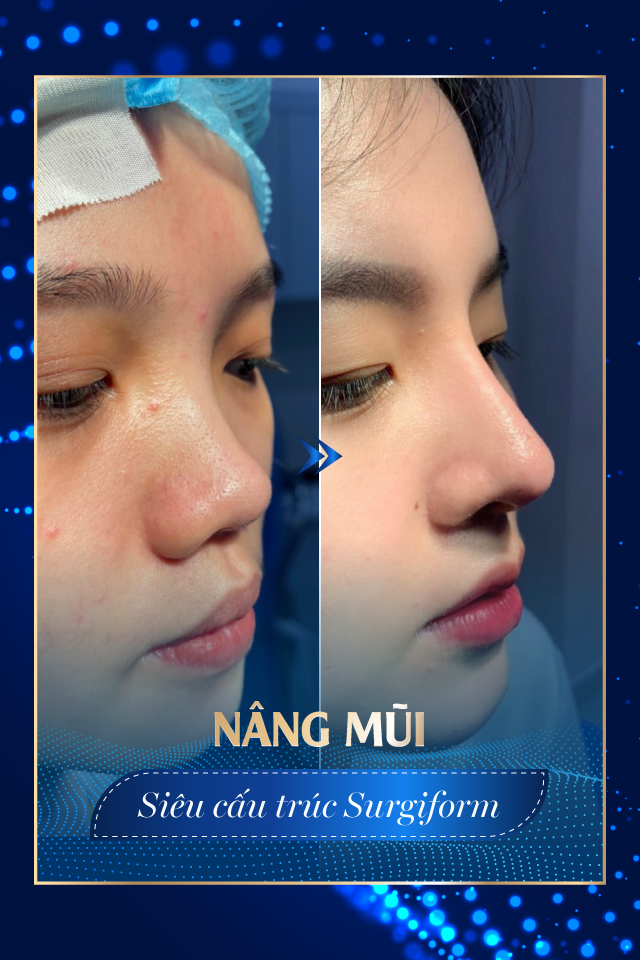 Nâng mũi công nghệ cao - Tmv Nguyễn Thế Thạnh