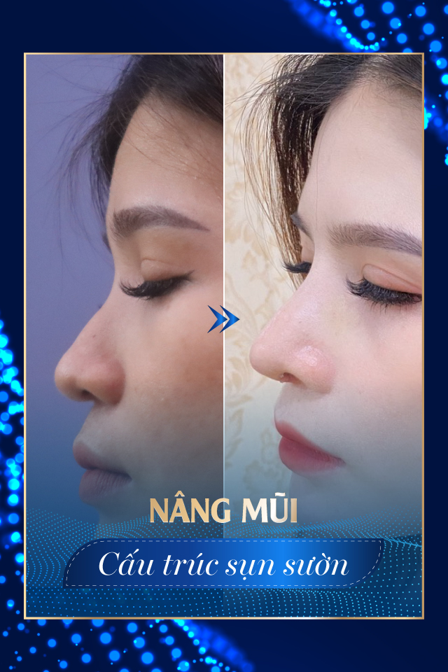 Nâng mũi công nghệ cao - Tmv Nguyễn Thế Thạnh
