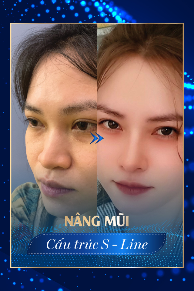 Nâng mũi công nghệ cao - Tmv Nguyễn Thế Thạnh