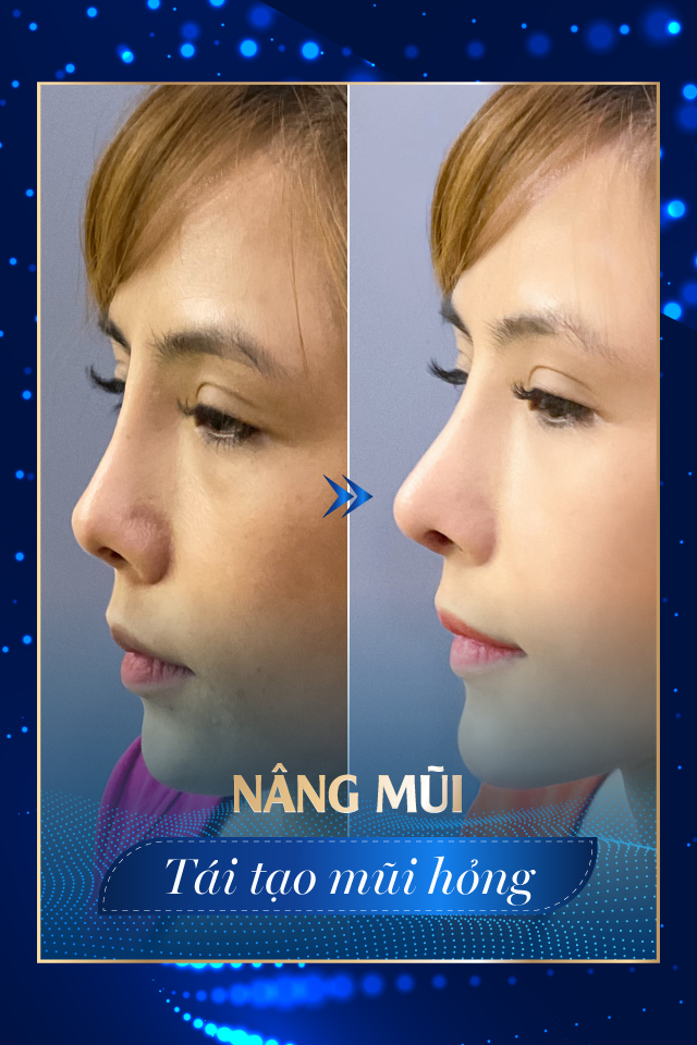Nâng mũi công nghệ cao - Tmv Nguyễn Thế Thạnh