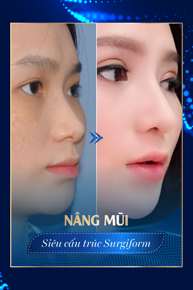 Nâng mũi công nghệ cao - Tmv Nguyễn Thế Thạnh
