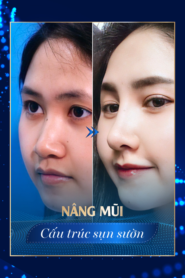 Nâng mũi công nghệ cao - Tmv Nguyễn Thế Thạnh