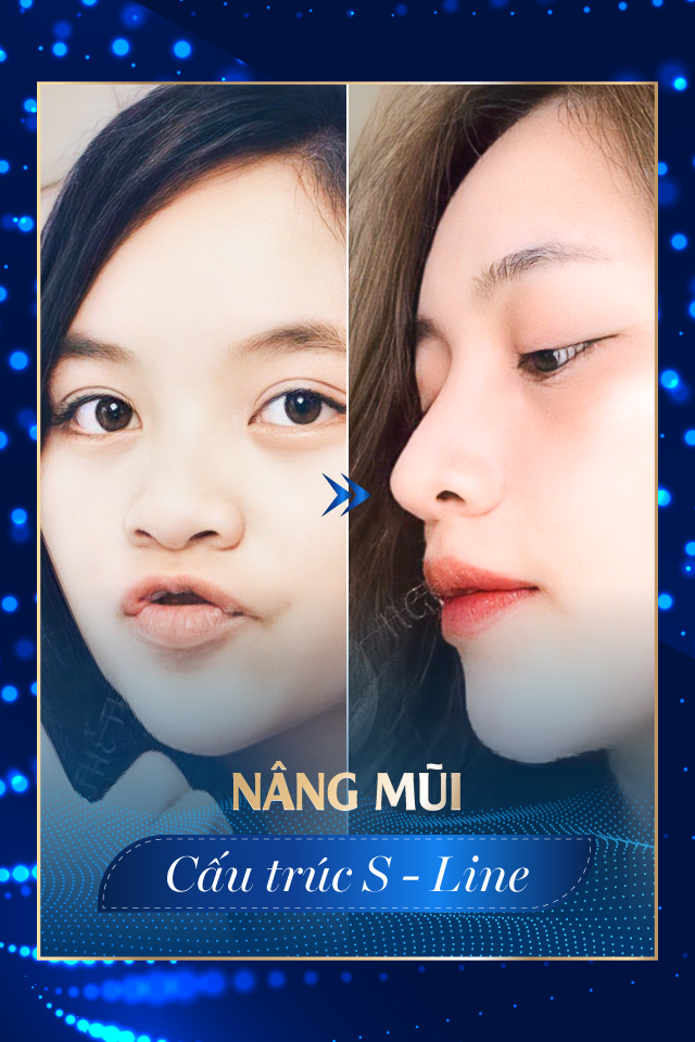 Nâng mũi công nghệ cao - Tmv Nguyễn Thế Thạnh