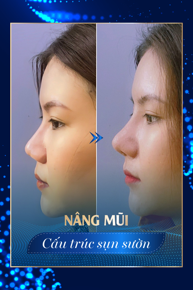 Nâng mũi công nghệ cao - Tmv Nguyễn Thế Thạnh